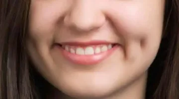 حصريًا في اليوم العالمي للغمازات اكتشف أنواعها وسماتها المميزة